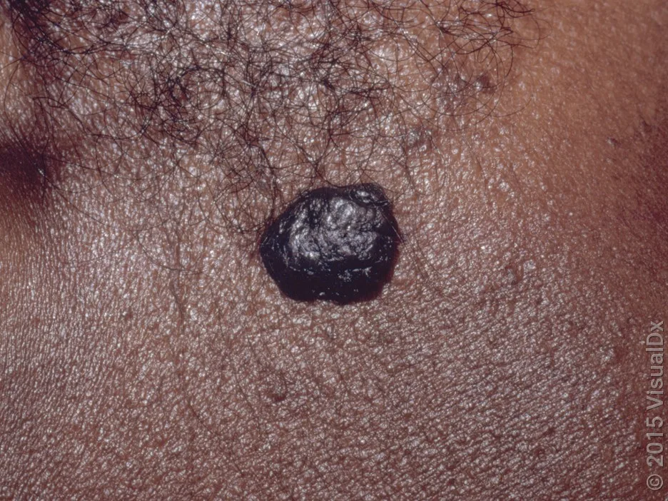 Close-up of a seborrheic keratosis