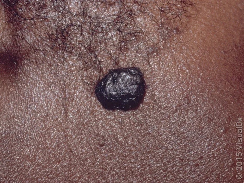 Close-up of a seborrheic keratosis