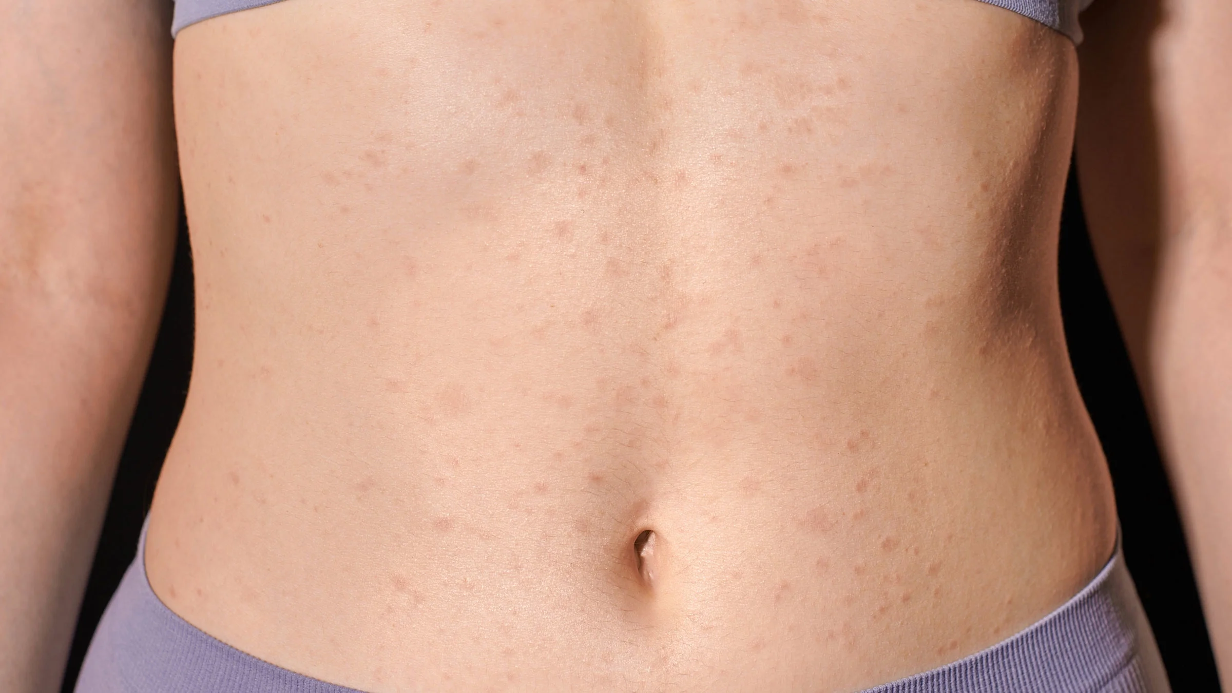 Close-up woman's torso with skin allergy