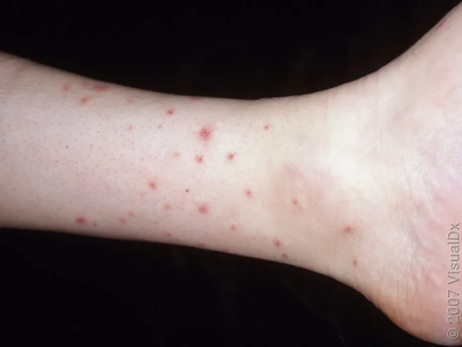 Close-up of flea bites around the ankle and lower leg.
