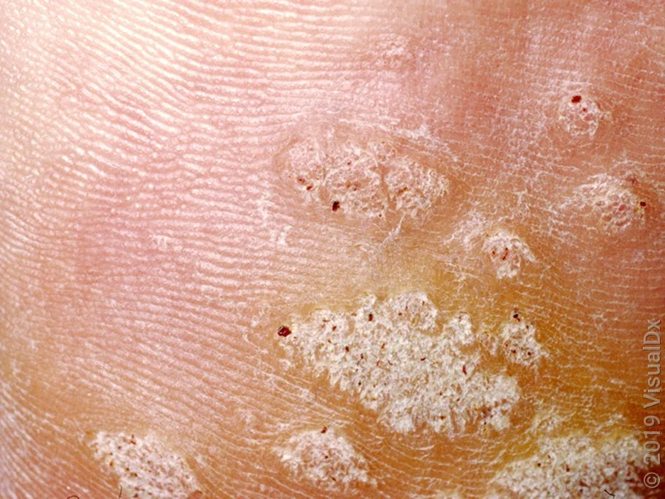 Small black and red dots are commonly seen in plantar warts. 