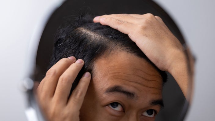 Man examines his scalp for signs of hair regrowth.