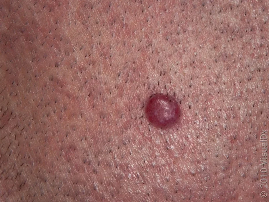 Close-up of a cherry angioma on the scalp. 