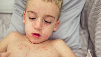 Measles: child with measles 1459397706