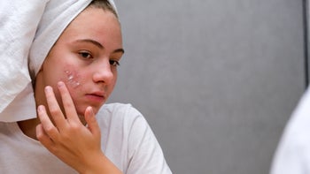 Mupirocin: applying acne cream 1364950528