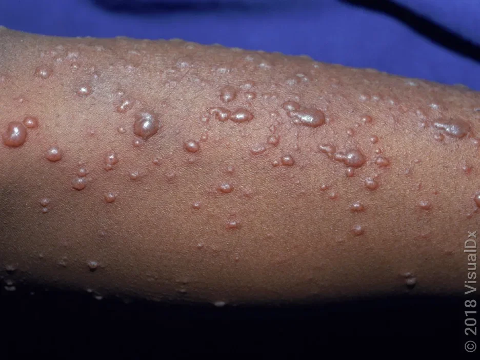 Close-up of chickenpox blisters on the skin of a Black person.