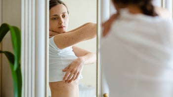 Health: Shingles: woman scratching her side 1387794697