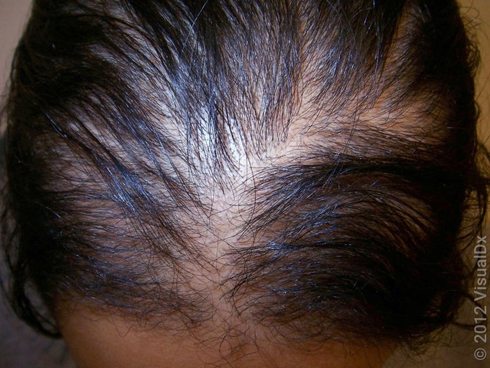 Close-up of a wide hair part and hair loss pattern in a woman. 
