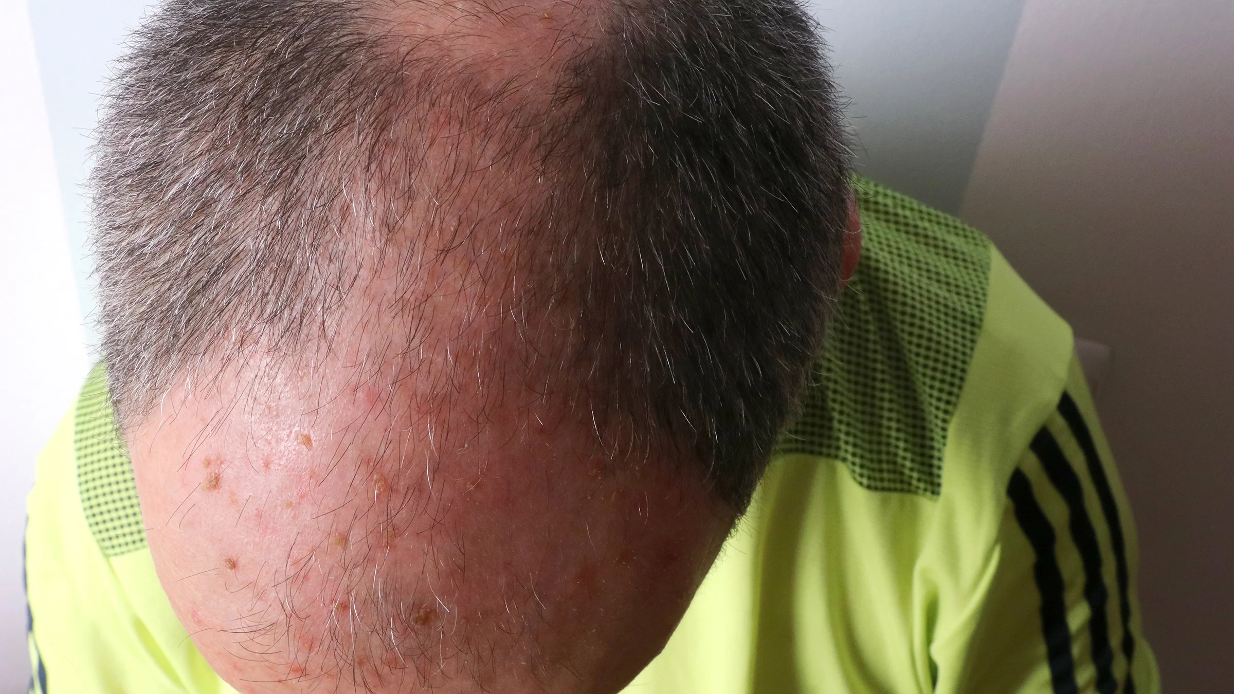 A man has actinic keratosis on his scalp.