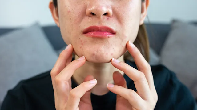 Alcohol and Accutane (Isotretinoin): Why This Combination Is a Bad Idea for Your Liver