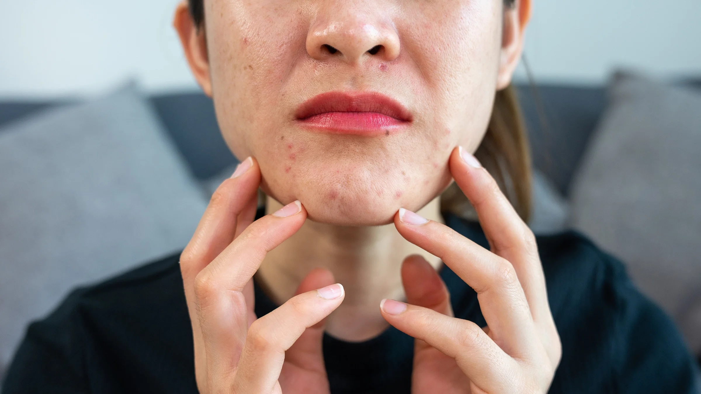 An image shows a close-up view of the lower half of a woman’s face, blemished with acne.