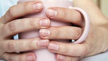 Health: Dermatology: closeup white spots nails 1270316146