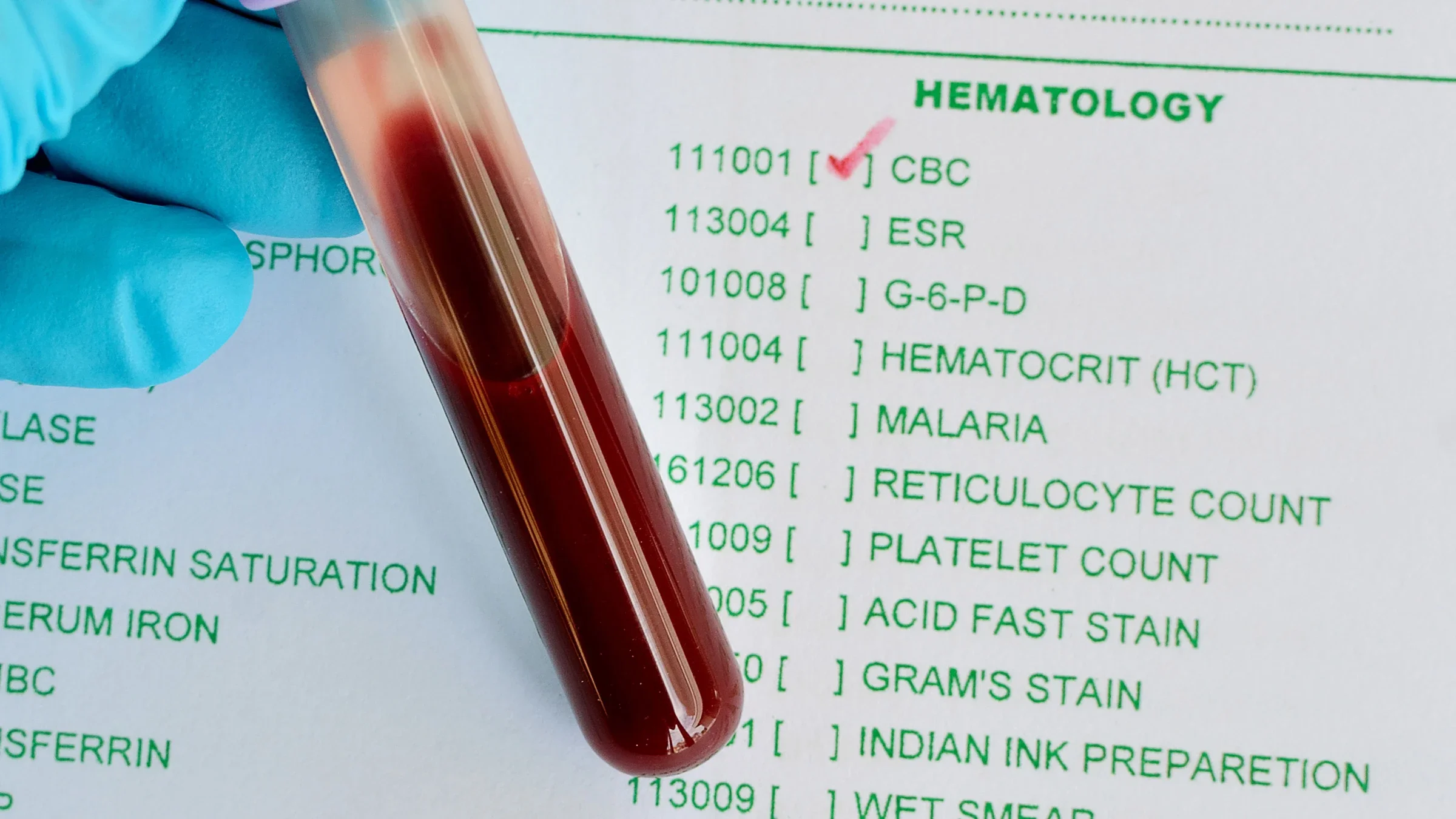 Diagnostics: blood test cbc 479562208