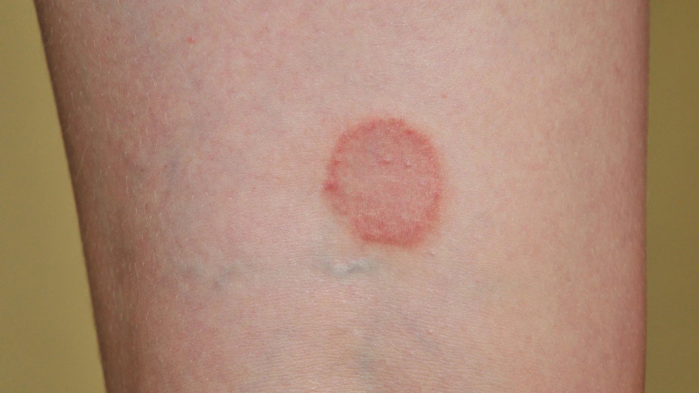 Close-up of a person's leg with ringworm.
reanas/iStock via Getty Images
