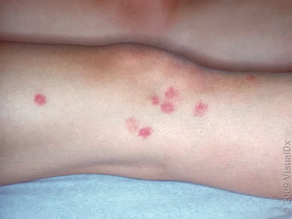 Close-up of a cluster of bedbug bites on the leg.