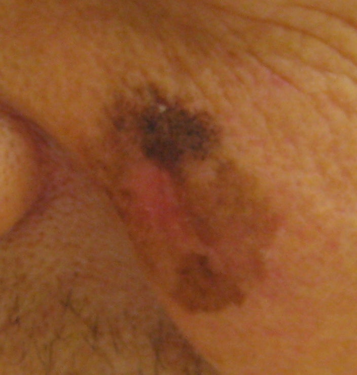 Is That A Brown Recluse Spider Bite Or Skin Cancer?
