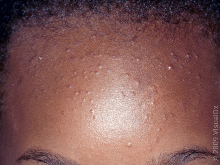 Many tiny, white and flesh-colored skin bumps (whiteheads) on the forehead. 