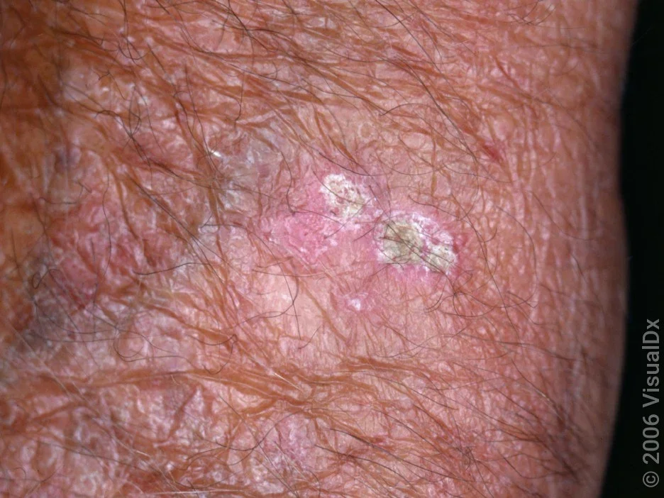 Close-up of an actinic keratosis.