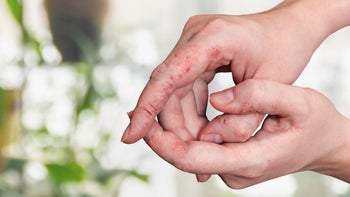 Dermatology: closeup psoriasis woman hands 1340902531