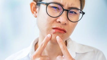 Dermatology: woman with cold sore 1362634344