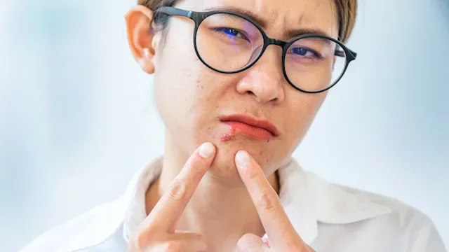 Dermatology: woman with cold sore 1362634344