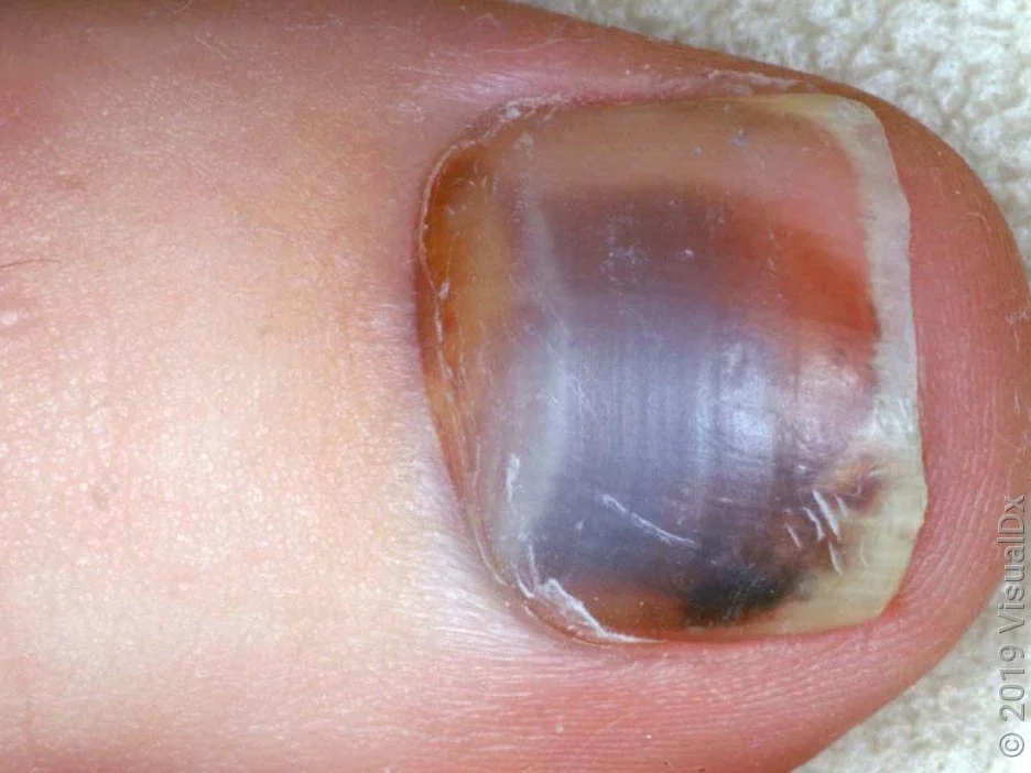 Close-up of a dark-red subungual hematoma.
