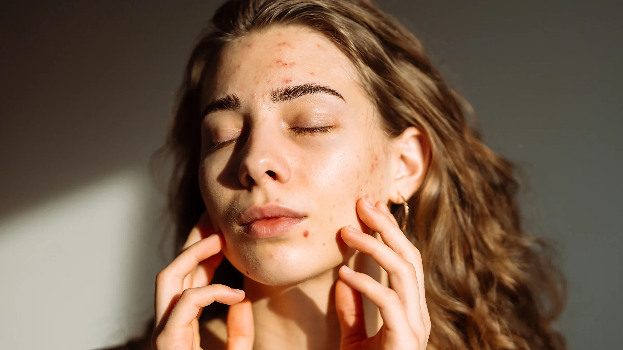 A portrait of a woman with acne on her face.
Maksym Belchenko/iStock via Getty Images