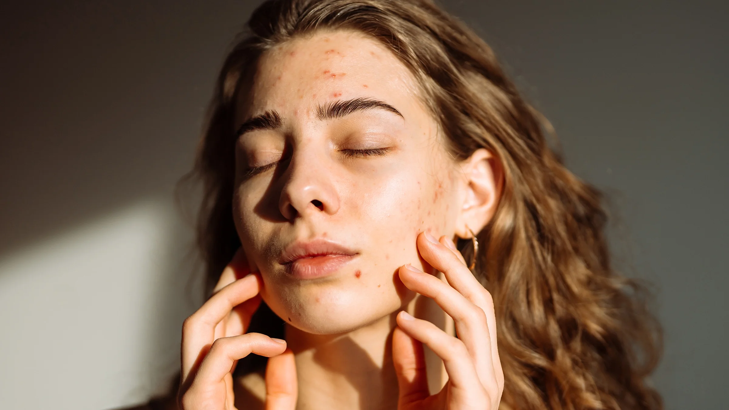 A portrait of a woman with acne on her face.