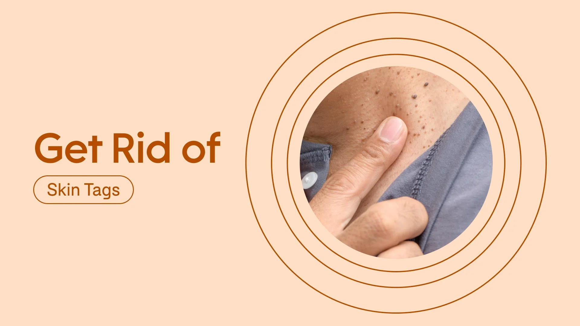 Light red-pink background with red text reading “Get Rid of Skin Tags” on the left-hand side. On the right is a circular cropped image of a person pointing to a skin tag on their neck. There are radial red circles framing it. 