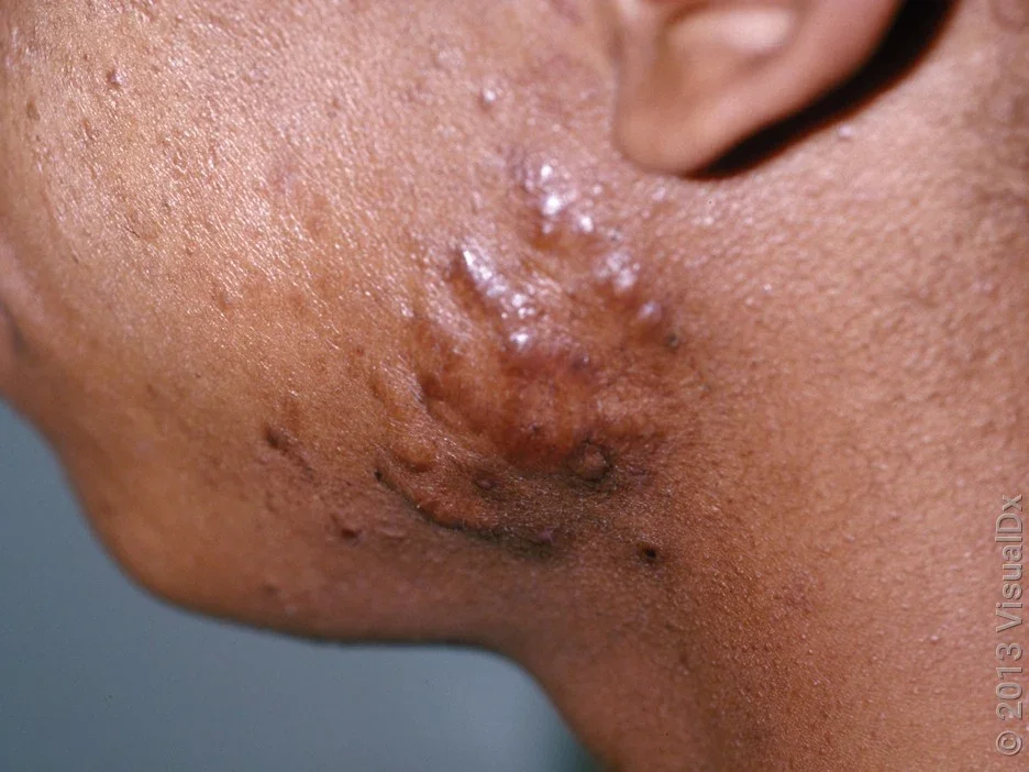 Close-up of keloids on the face from acne. 