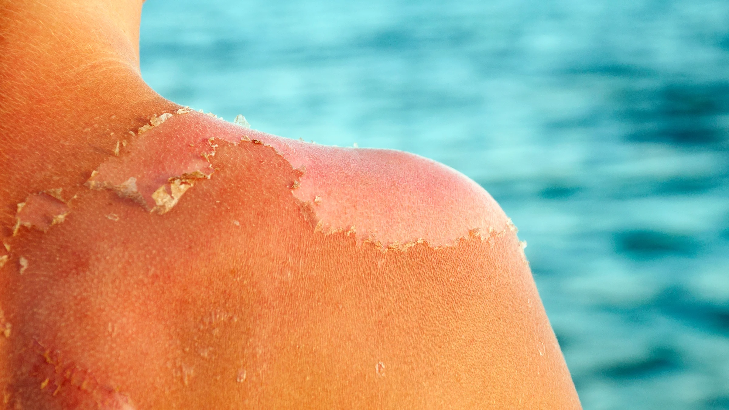Cropped shot of a person's peeling sunburnt shoulder. The back ground is the water of a lake or pool.