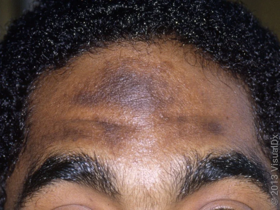 Close-up of eczema and postinflammatory hyperpigmentation on the face. 