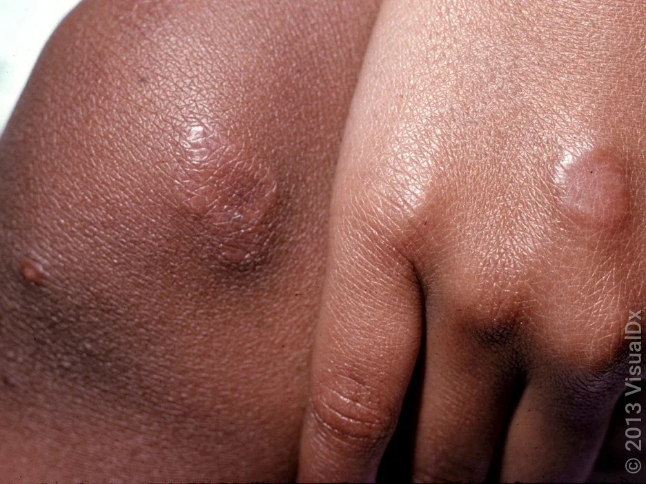 Close-up of granuloma annulare on the hand and knee. 