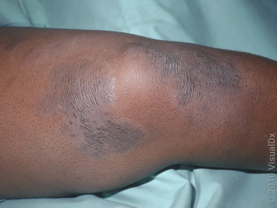 Eczema on dark skin on the leg. 