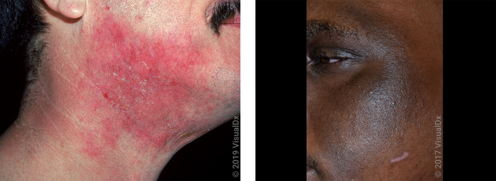 Is It Eczema on My Face Facial Eczema Images GoodRx