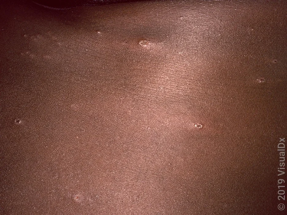 Early chickenpox on the skin of a Black person. 