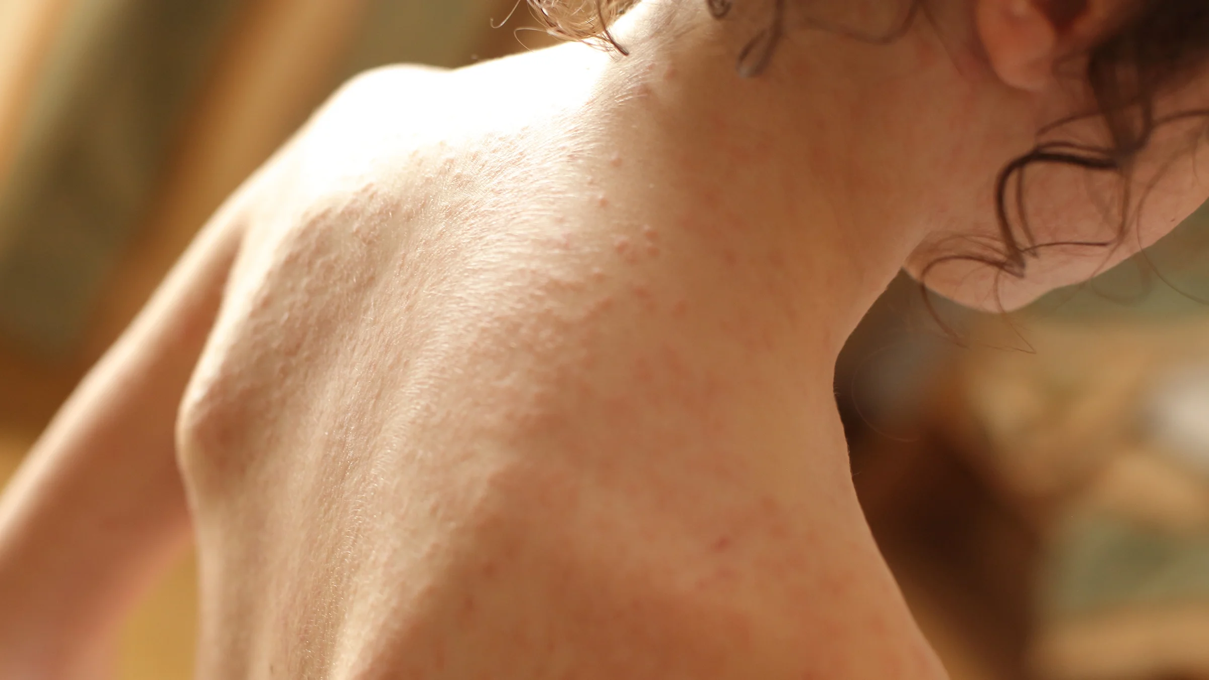 Child’s back with scarlet fever rash.