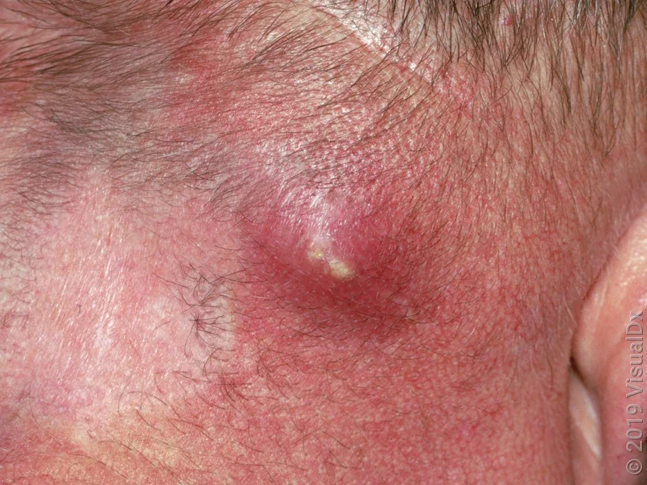 A skin abscess on the neck with visible pus. 