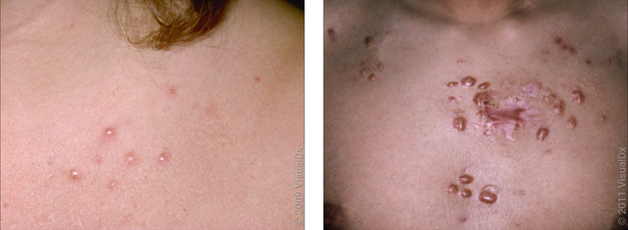 Left: Close-up of several smooth, pink bumps. Right: Many smooth, brown and red skin bumps on the chest.