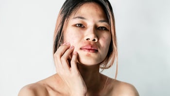 Health: Psoriasis: portrait young woman with skin rashes-1365786201