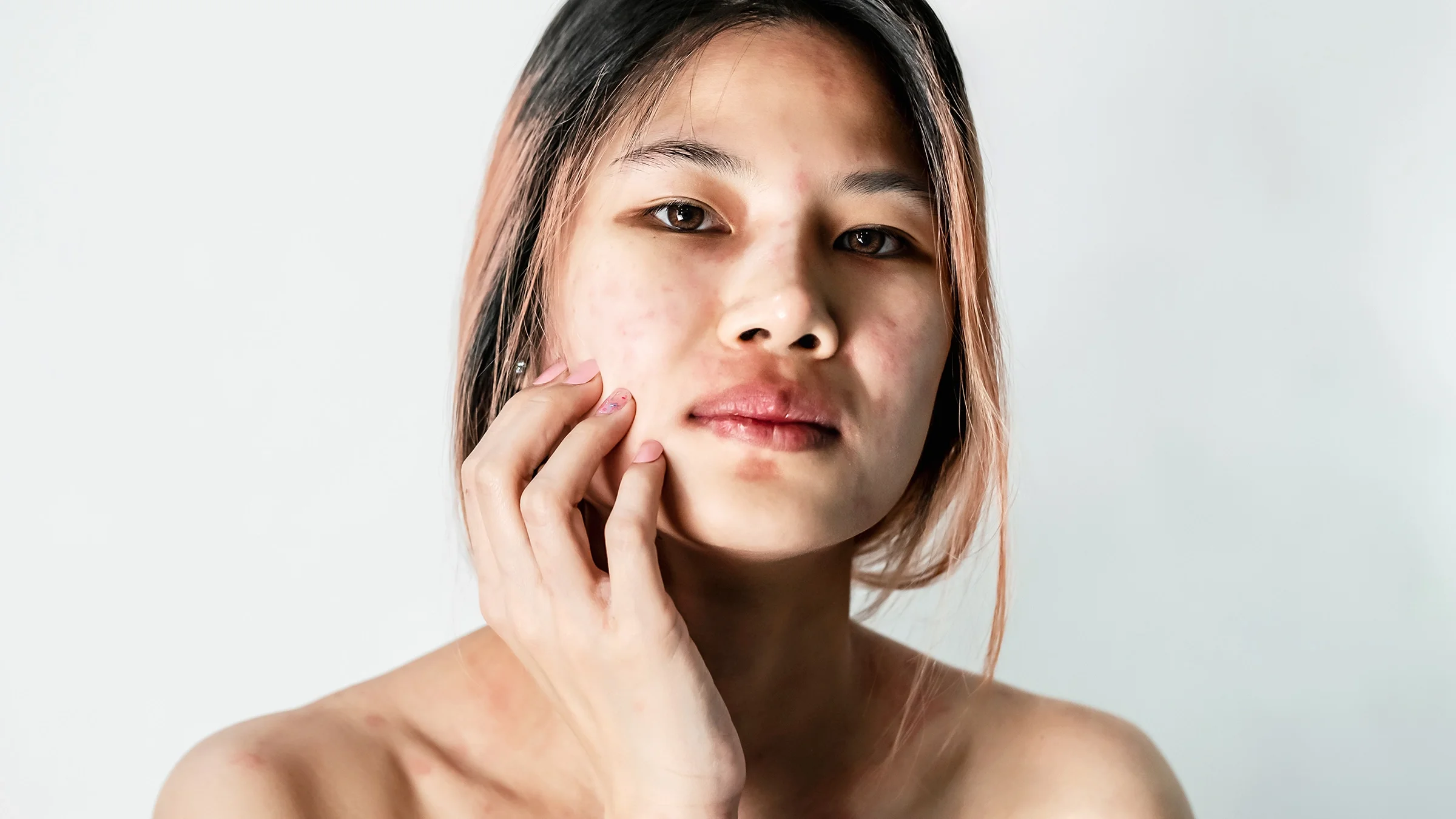 Portrait of a young woman with skin rashes all on her face, hands, and neck.