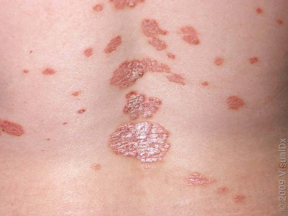 Close-up of back with round pink, scaly patches of psoriasis. 