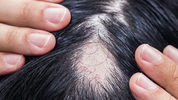 Autoimmune: closeup hair loss 1264331253
