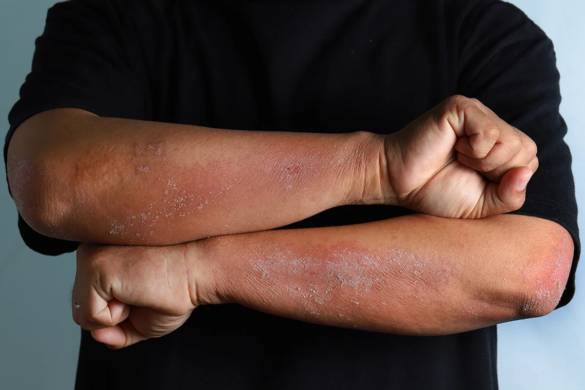 Cropped close-up of a man's psoriasis on his forearms, his arms are stacked on top of each other.