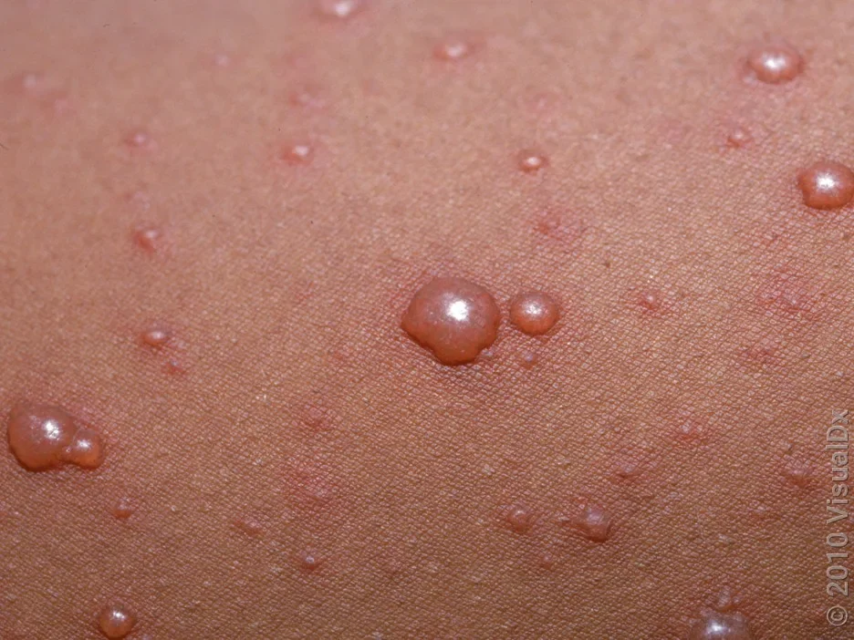 Close-up of small blisters on a person with darker skin.