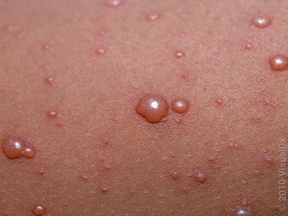 Close-up of small blisters on a person with darker skin. 