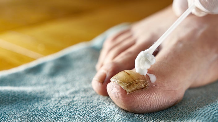 Someone with a crusty big toenail applies medicinal cream. Learn how to tell the difference between nail psoriasis and nail fungus.