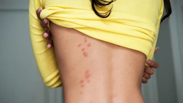 Environmental: closeup back bed bug bites 513433472
