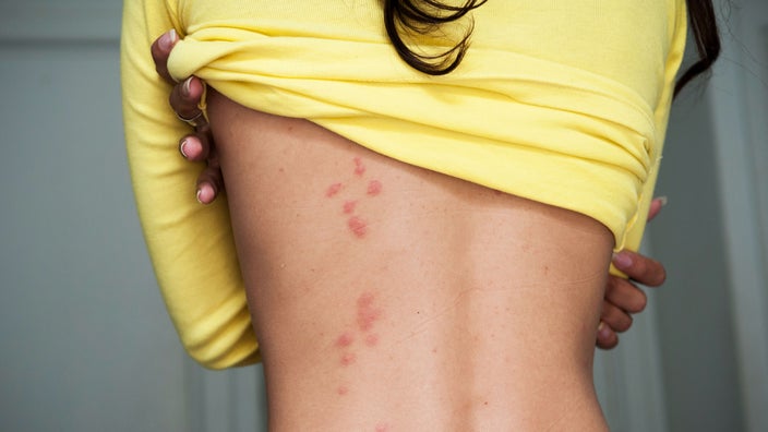 There are bedbug bites on the back of a woman standing in a room.