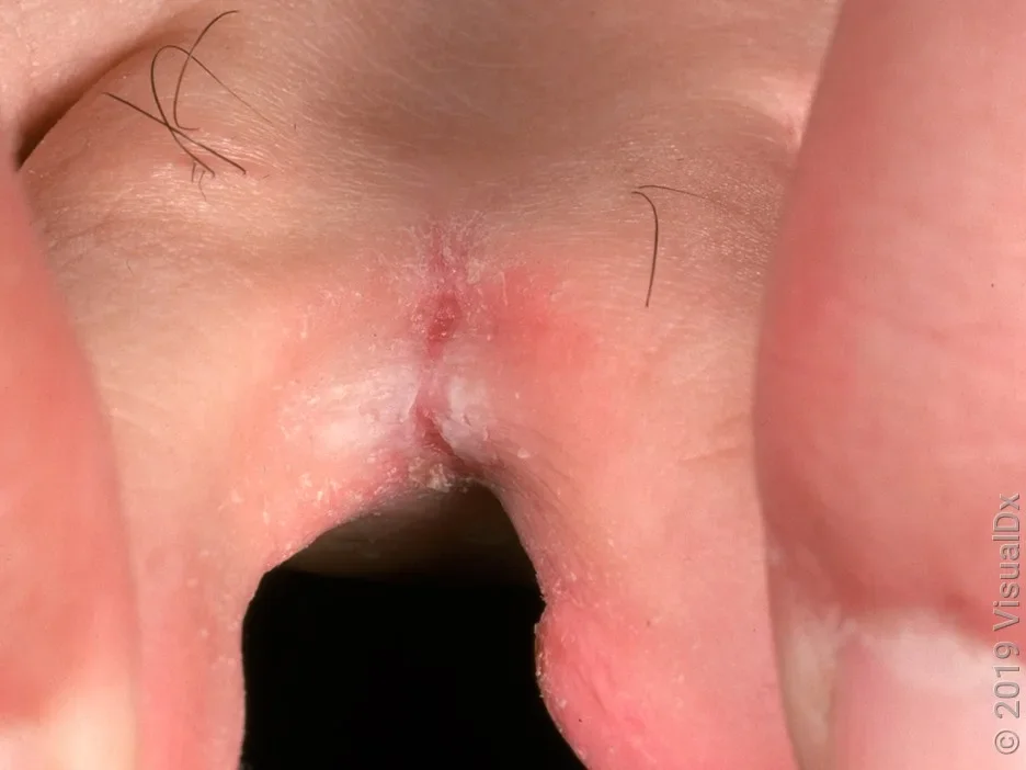 Athlete’s foot can cause white patches and peeling between toes. 